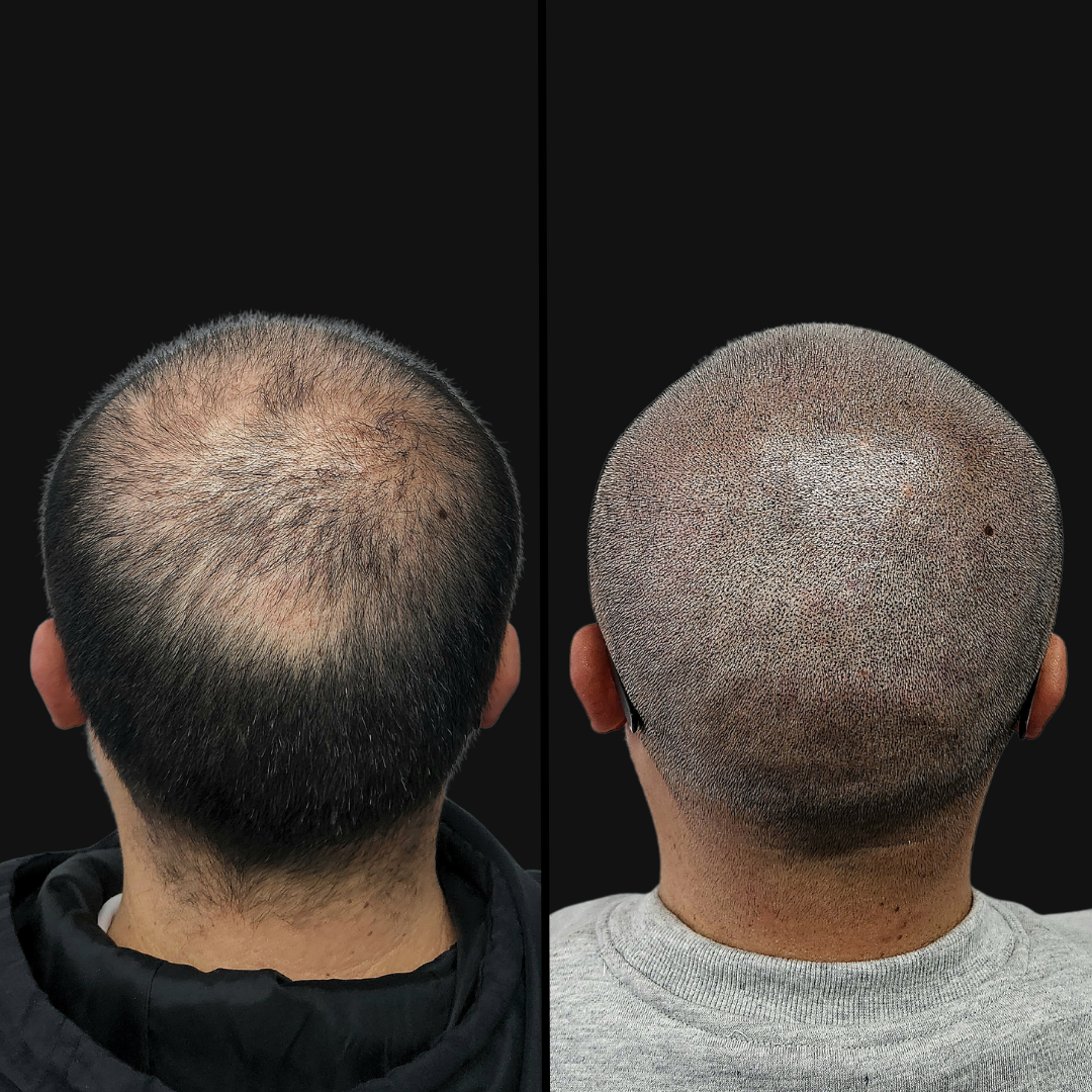 Densificacion-capilar-dotpro