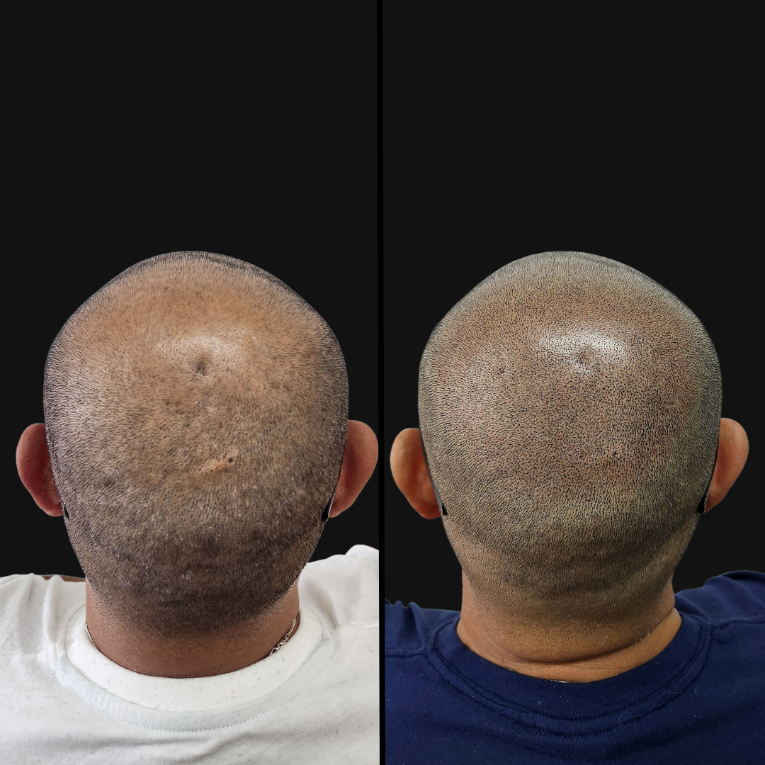 Densificacion-capilar-dotpro